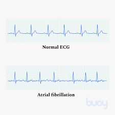 Atrial Fibrillation