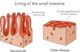 Celiac Disease: Your Questions Answered