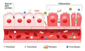 Leaky Gut Basics 2013