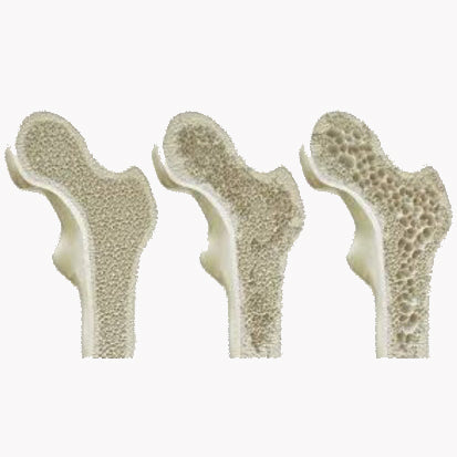 Osteoporosis Treatment Basics