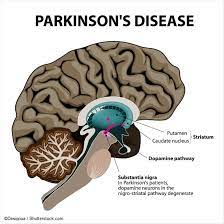 Gluten Sensitivity and Parkinson's Disease